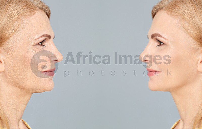 Mature Woman Before And After Cosmetic Procedure On Grey Background