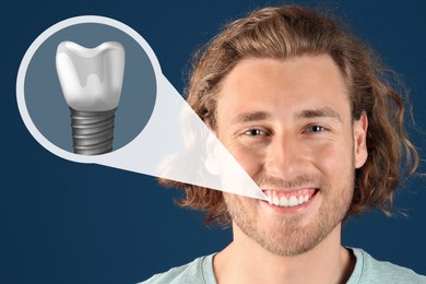 Image of Happy man with perfect teeth smiling on dark blue background. Illustration of dental implant
