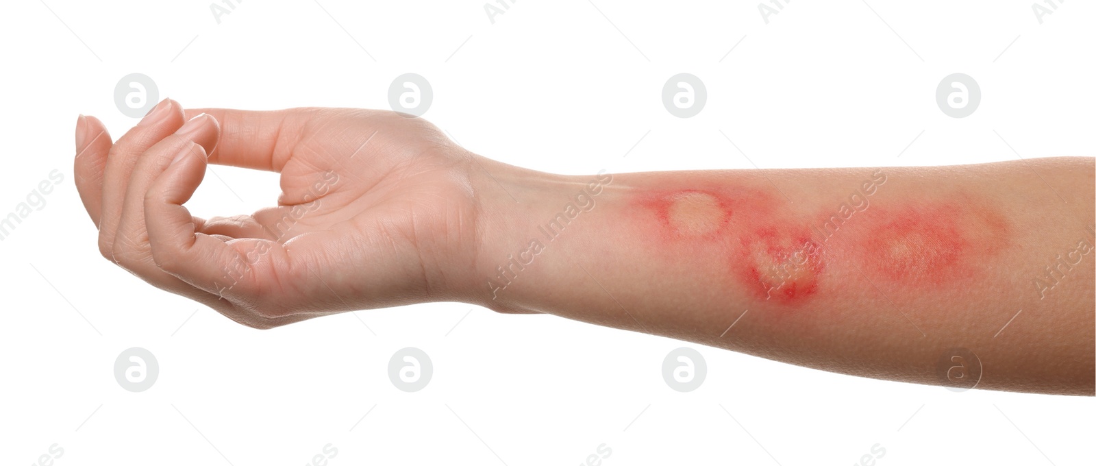 Photo of Woman with burned hand on white background, closeup