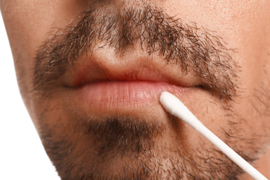 Young man with cold sore applying cream on lips against white background, closeup