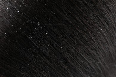 Photo of Closeup view of dark woman`s hair with dandruff