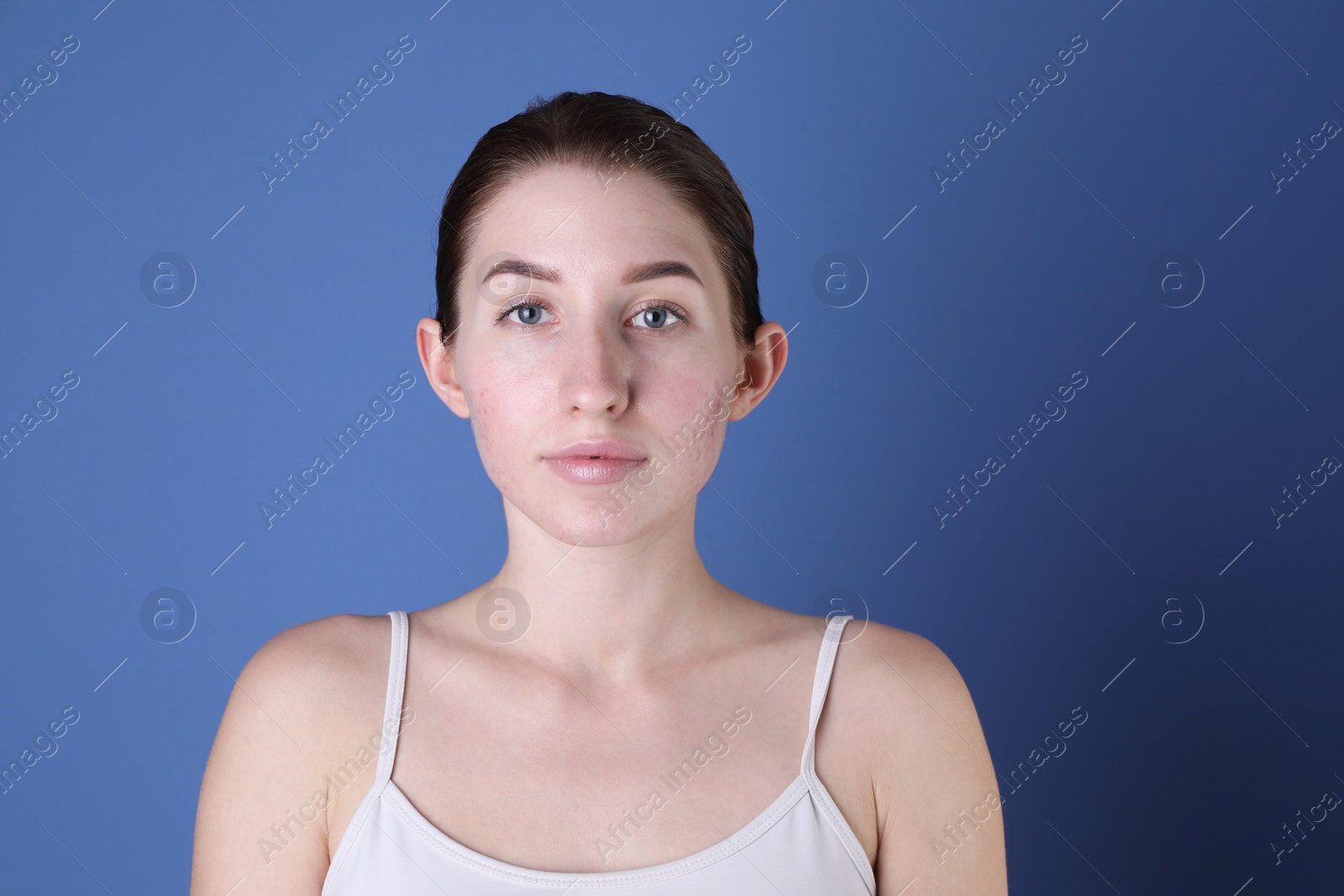 Photo of Young woman with acne problem on blue background