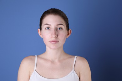 Photo of Young woman with acne problem on blue background