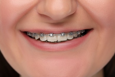 Photo of Smiling woman with dental braces, closeup view