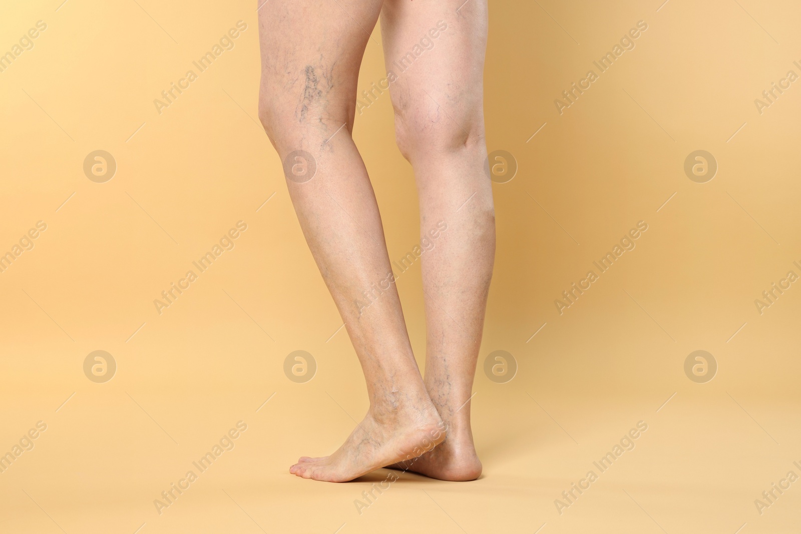 Photo of Closeup view of woman with varicose veins on yellow background