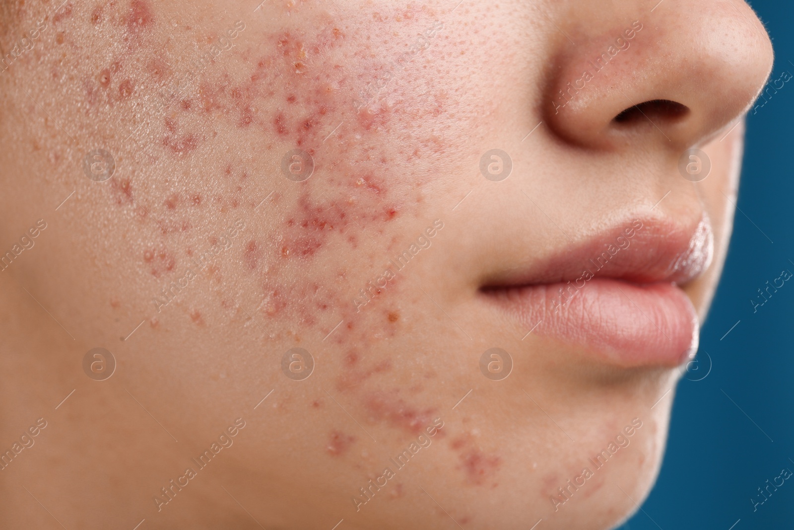 Photo of Teenage girl with acne problem on blue background, closeup