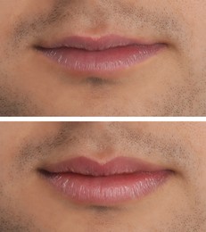 Image of Collage with photos of man before and after lips augmentation, closeup