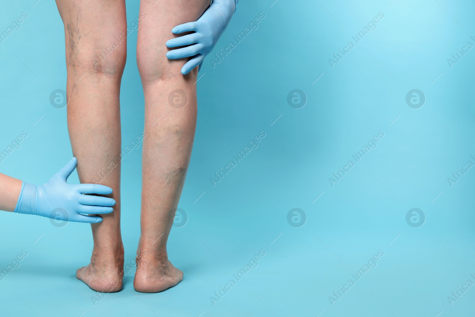 Photo of Doctor examining patient with varicose veins on light blue background, closeup. Space for text