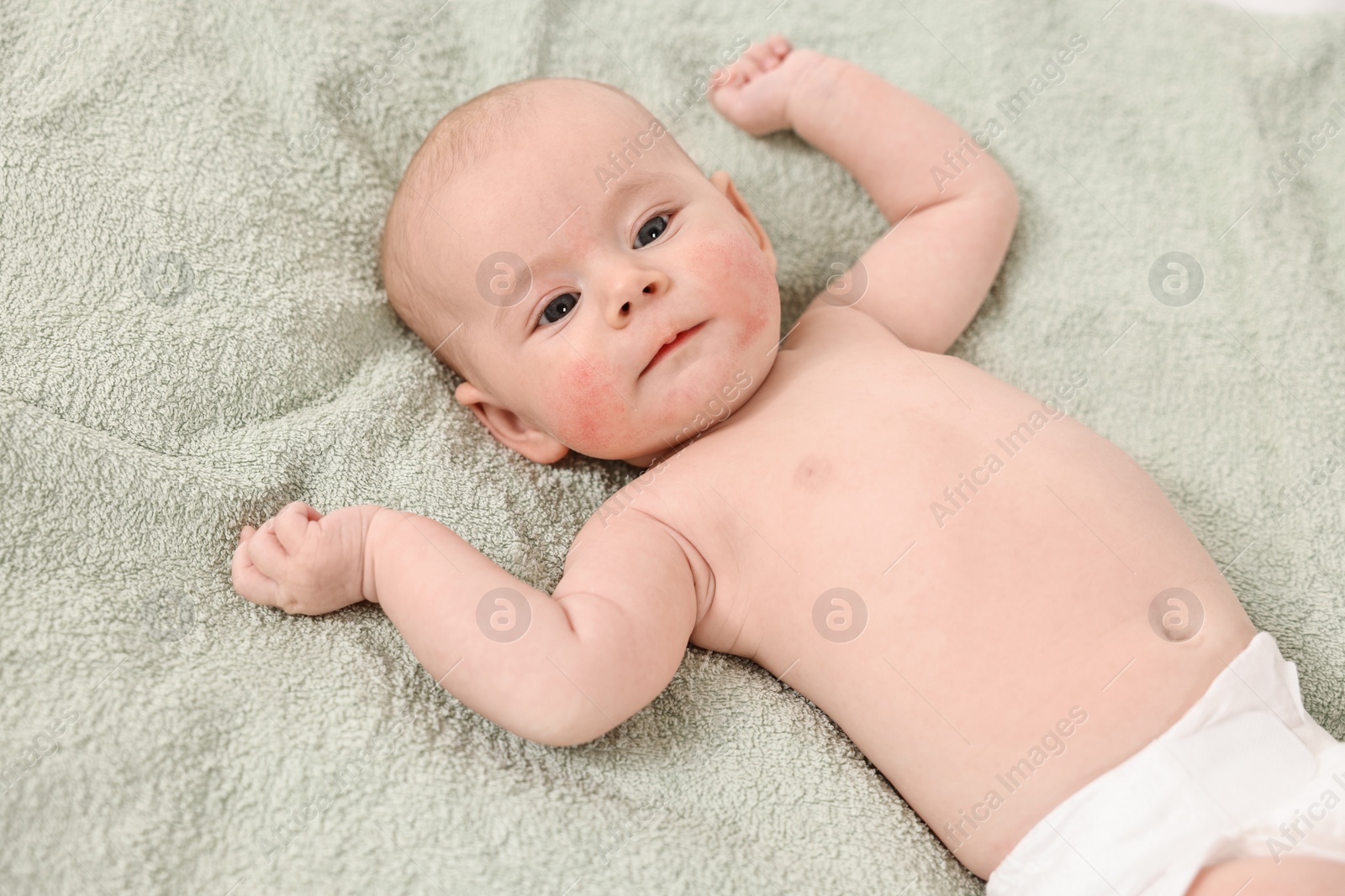 Photo of Cute little baby with allergic redness on cheeks lying on light green blanket