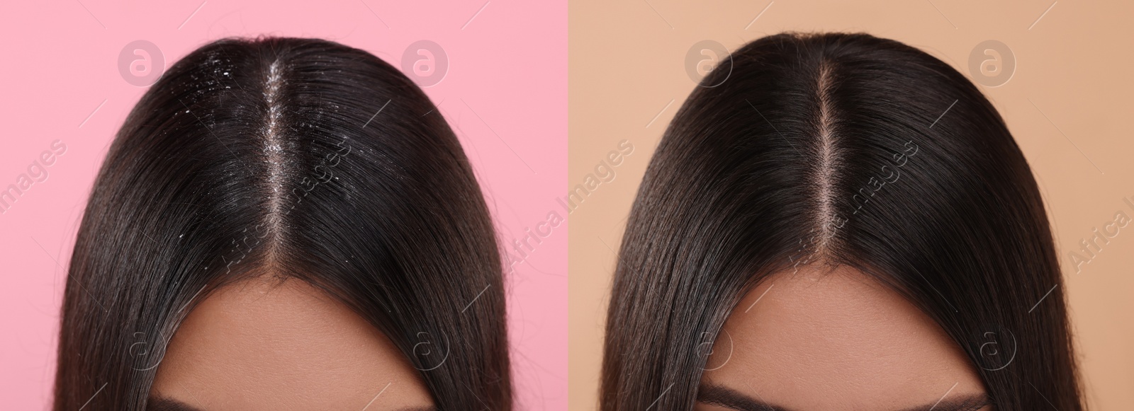 Image of Woman showing hair before and after dandruff treatment on color backgrounds, collage