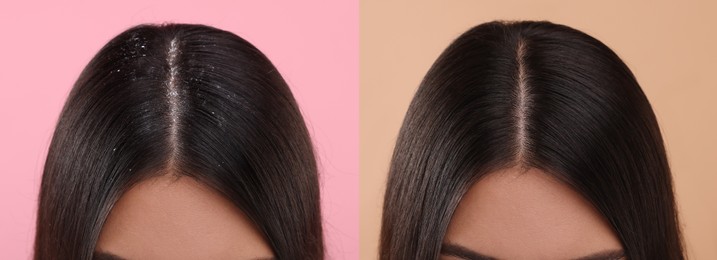 Woman showing hair before and after dandruff treatment on color backgrounds, collage