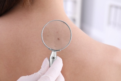 Dermatologist examining patient with magnifying glass in clinic, closeup view