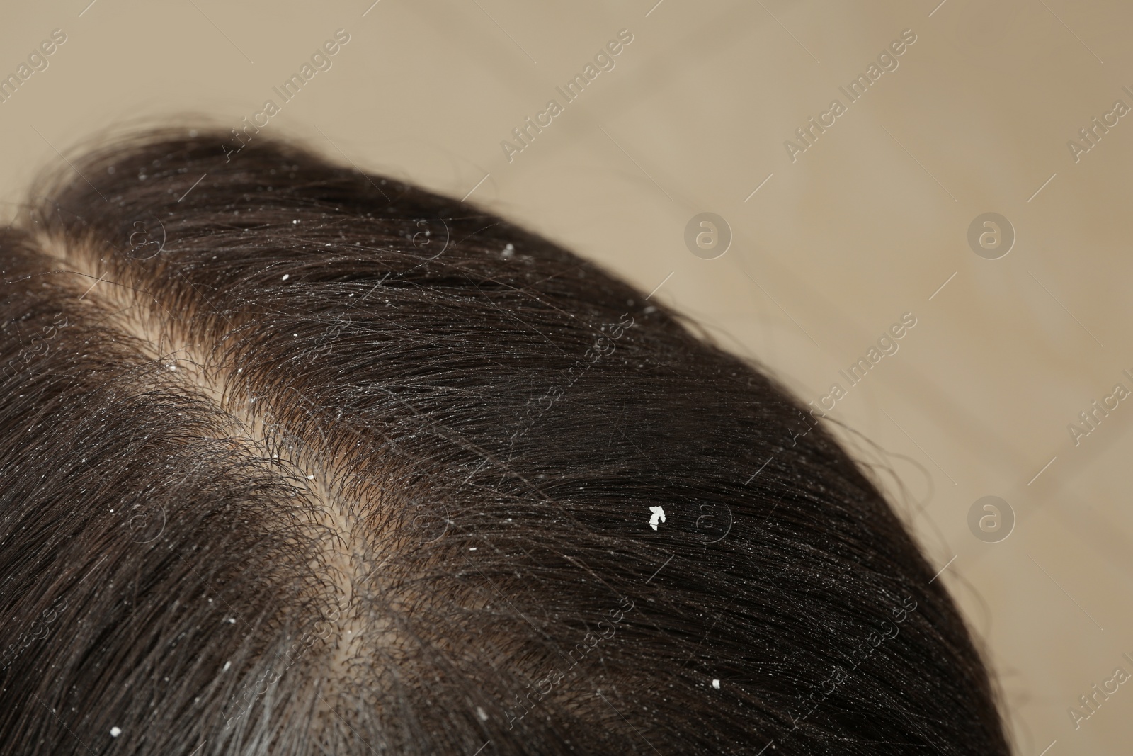 Photo of Woman with dandruff in her dark hair on blurred background, closeup view