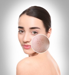 Woman with acne on her face on grey gradient background. Zoomed area showing problem skin