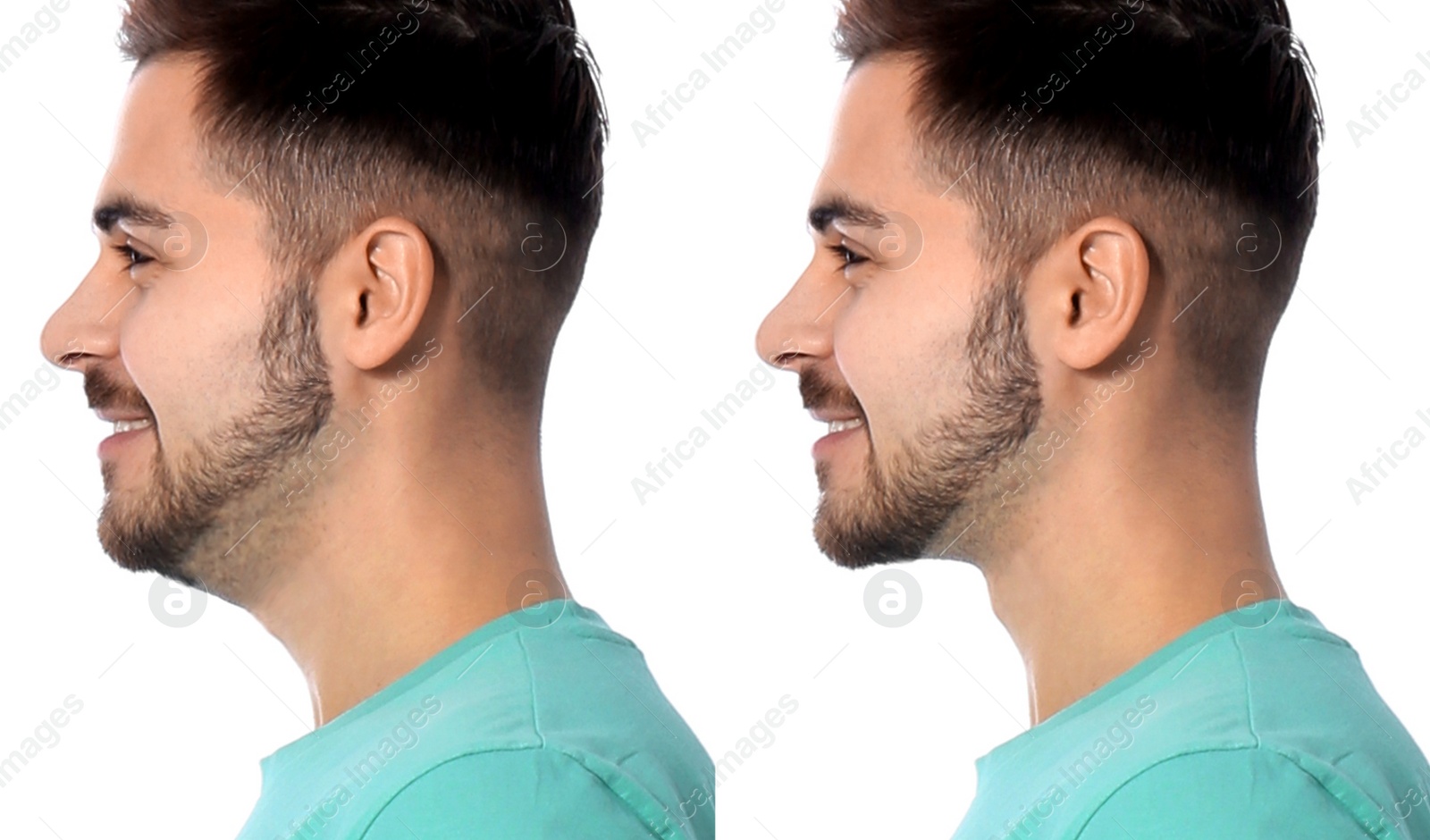 Image of Double chin problem. Collage with photos of man before and after plastic surgery procedure on white background