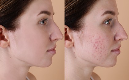 Acne problem. Young woman before and after treatment on beige background, collage of photos