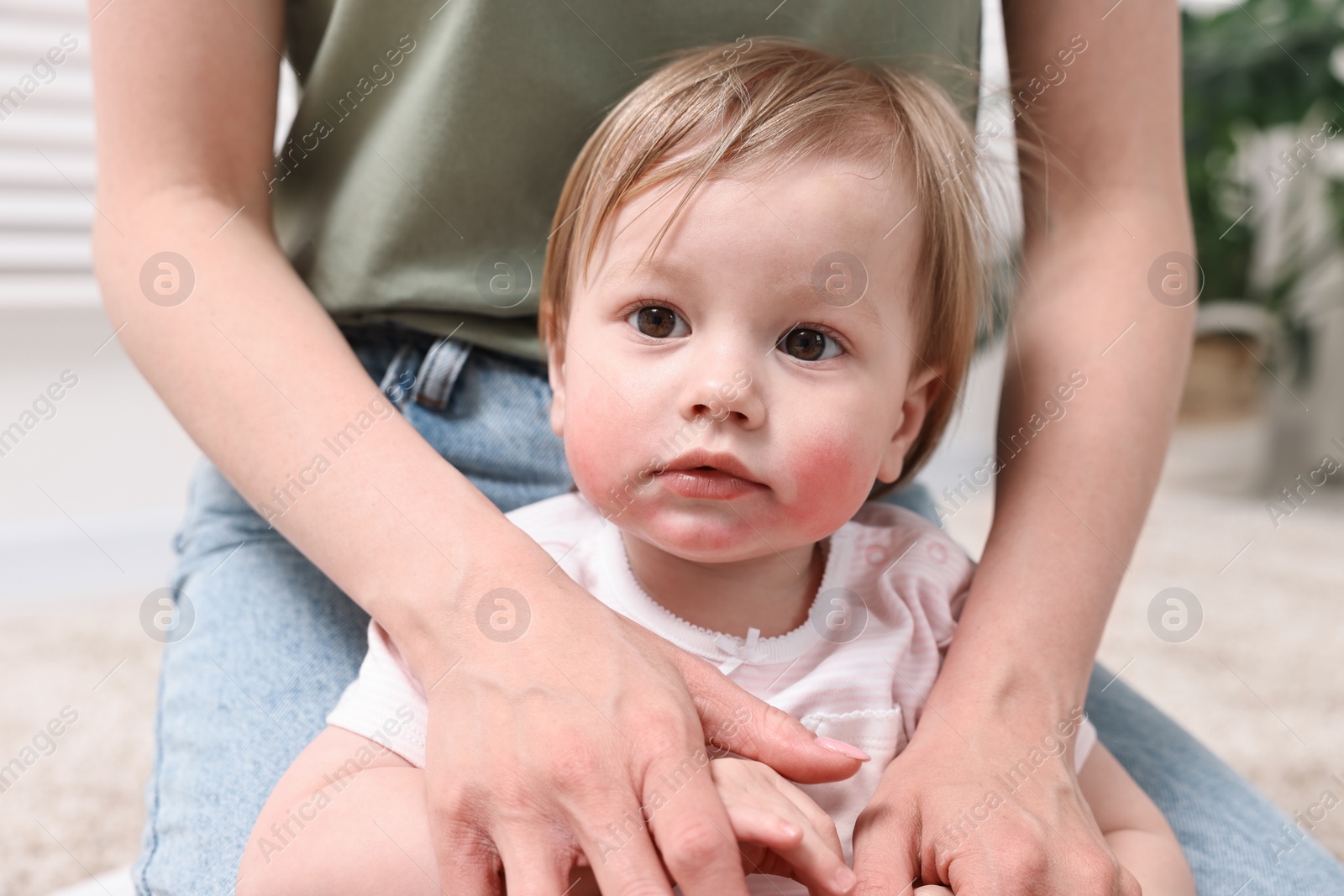 Photo of Mother and daughter with diathesis symptom on cheeks indoors, closeup