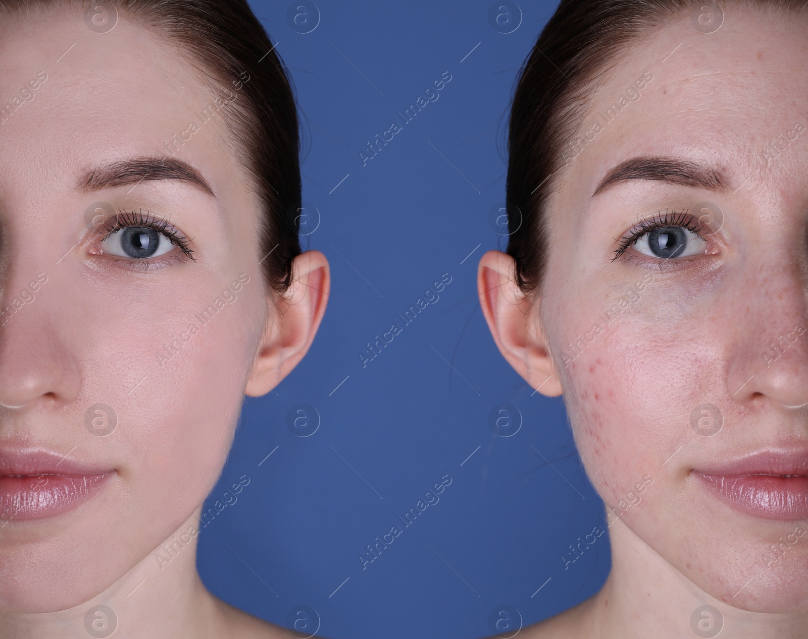 Image of Acne problem. Young woman before and after treatment on blue background, collage of photos