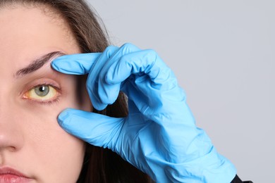 Photo of Doctor checking woman with yellow eyes on light background, closeup. Symptom of hepatitis