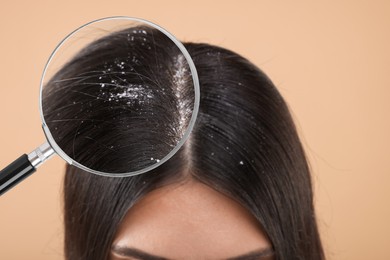 Woman suffering from dandruff on beige background, closeup. View through magnifying glass on hair with flakes