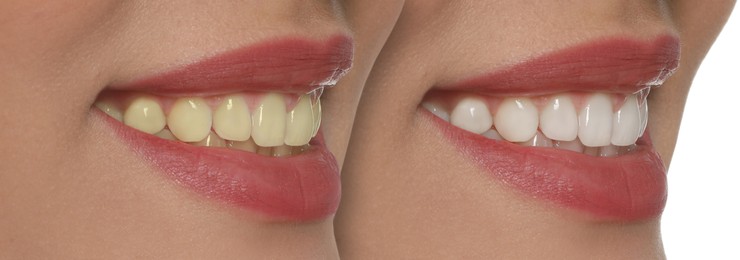 Collage with photos of woman before and after tooth whitening, closeup
