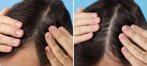 Man showing hair before and after dandruff treatment on light blue background, collage