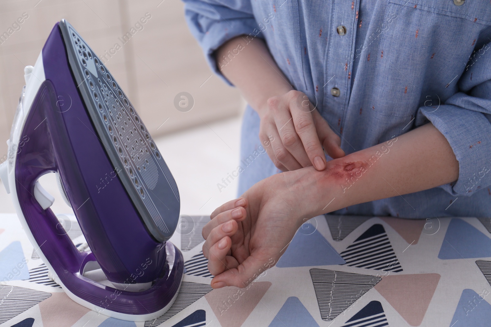 Photo of Woman with burn on her forearm near ironing board at home, closeup