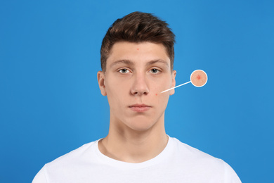 Teenage boy with acne problem on blue background