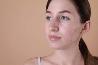 Photo of Young woman with acne problem on beige background. Space for text