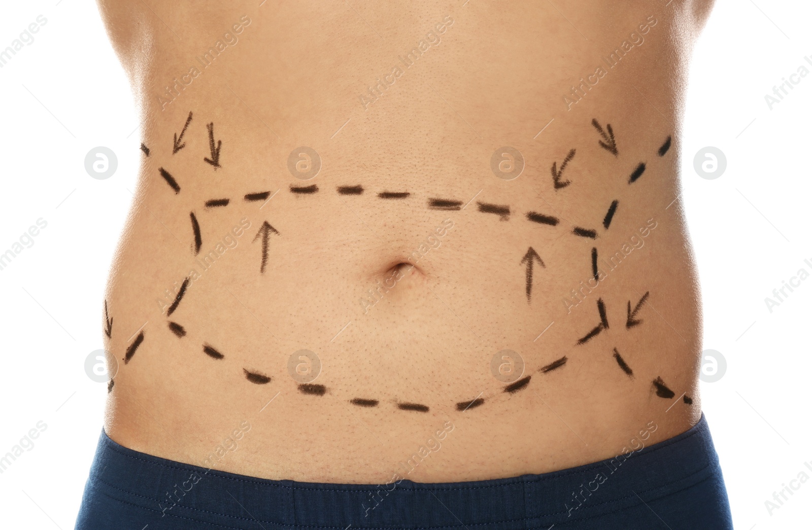 Photo of Young man with marks on belly for cosmetic surgery operation against white background, closeup