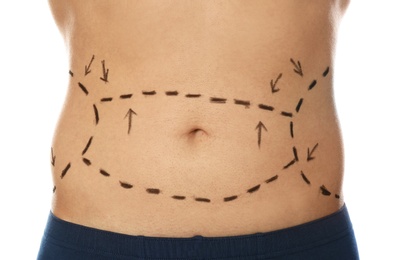 Photo of Young man with marks on belly for cosmetic surgery operation against white background, closeup