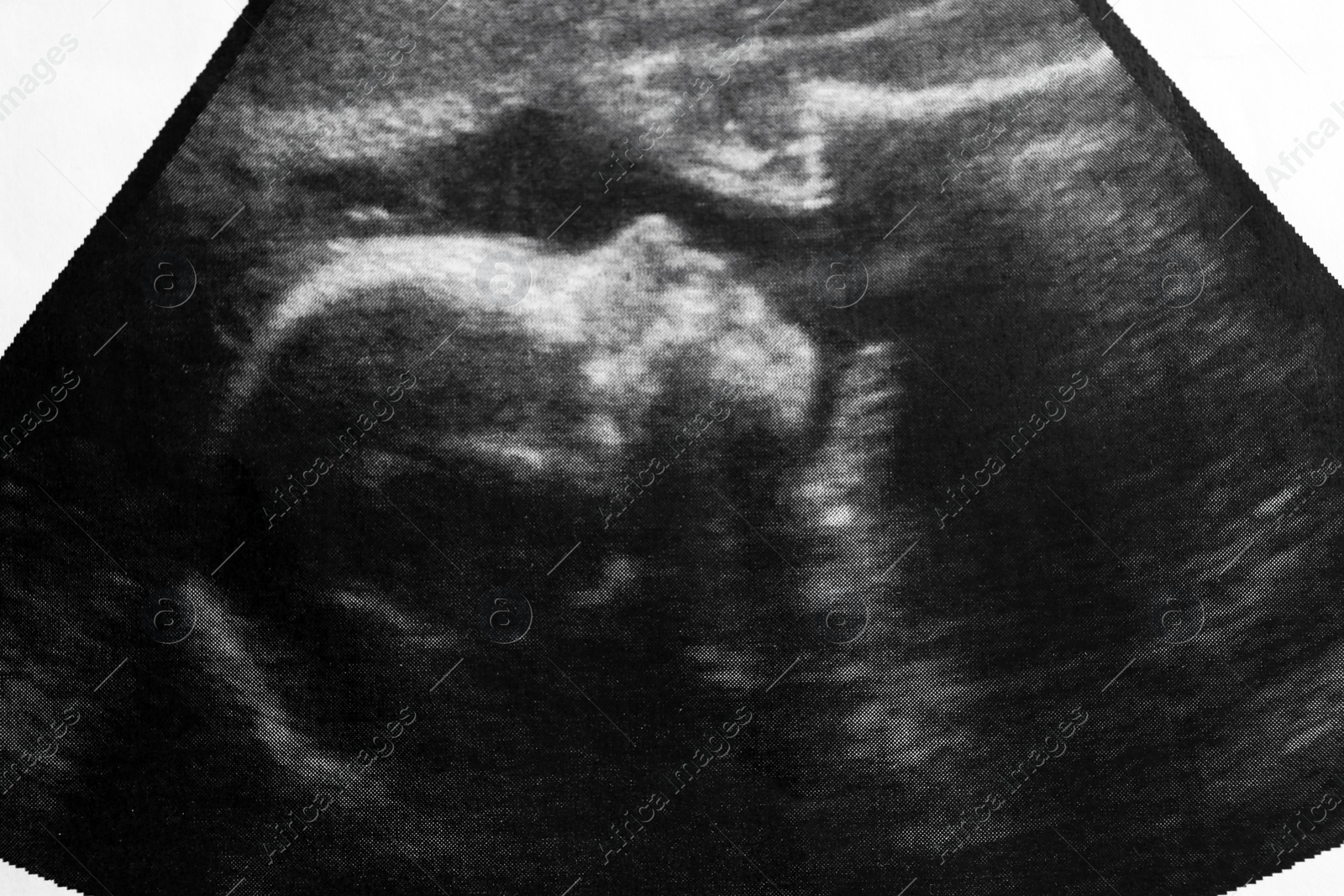 Photo of Ultrasound photo of unborn baby in mother's womb, closeup view