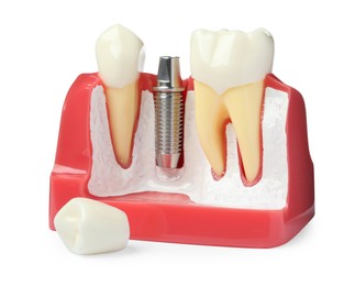 Photo of Educational model with post and abutment of dental implant between teeth near crown on white background