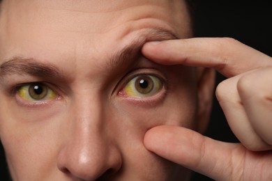 Photo of Man checking his health condition on black background, closeup. Yellow eyes as symptom of problems with liver