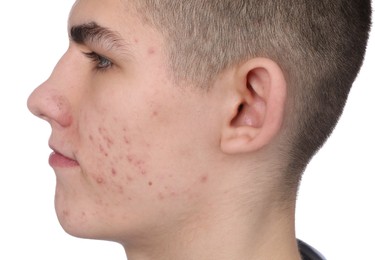 Photo of Young man with acne problem isolated on white