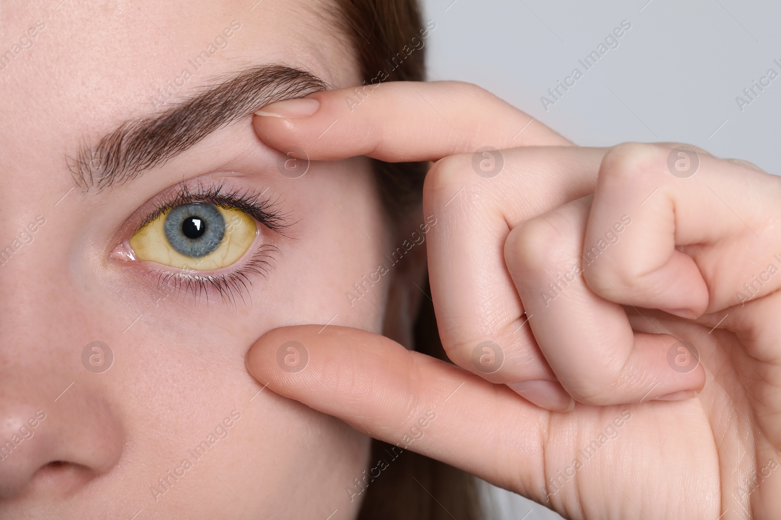 Photo of Woman with yellow eyes on white background, closeup. Symptom of hepatitis