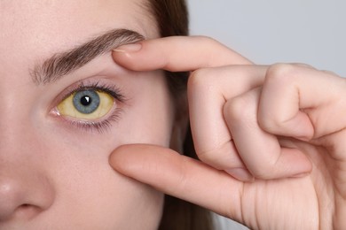 Woman with yellow eyes on white background, closeup. Symptom of hepatitis