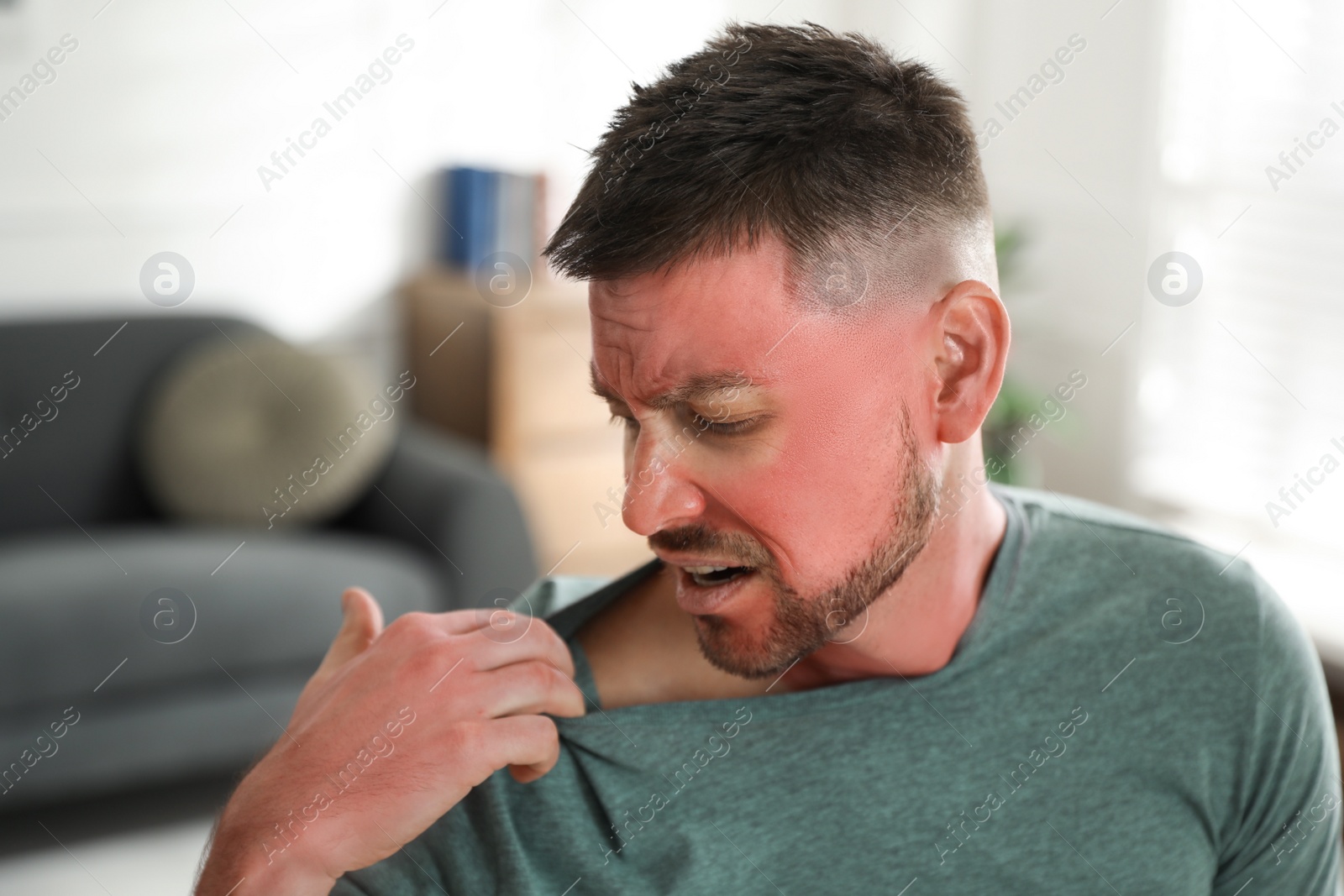 Photo of Man with sunburn on skin at home