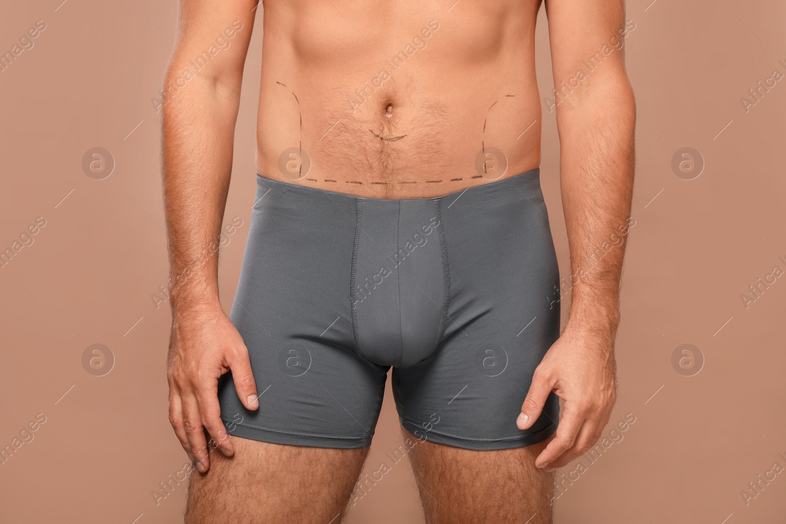 Photo of Man with markings on belly before cosmetic surgery operation on light brown background, closeup