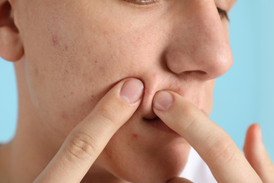 Photo of Teen guy with acne problem squeezing pimple on light blue background, closeup