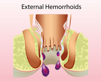 Image of External hemorrhoid. Unhealthy lower rectum with inflamed vascular structures, illustration