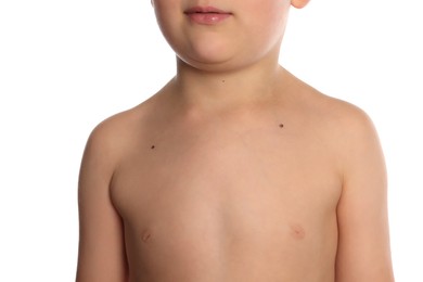 Photo of Closeup view of boy's body with birthmarks on white background