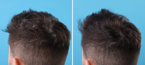 Image of Man showing hair before and after dandruff treatment on light blue background, collage