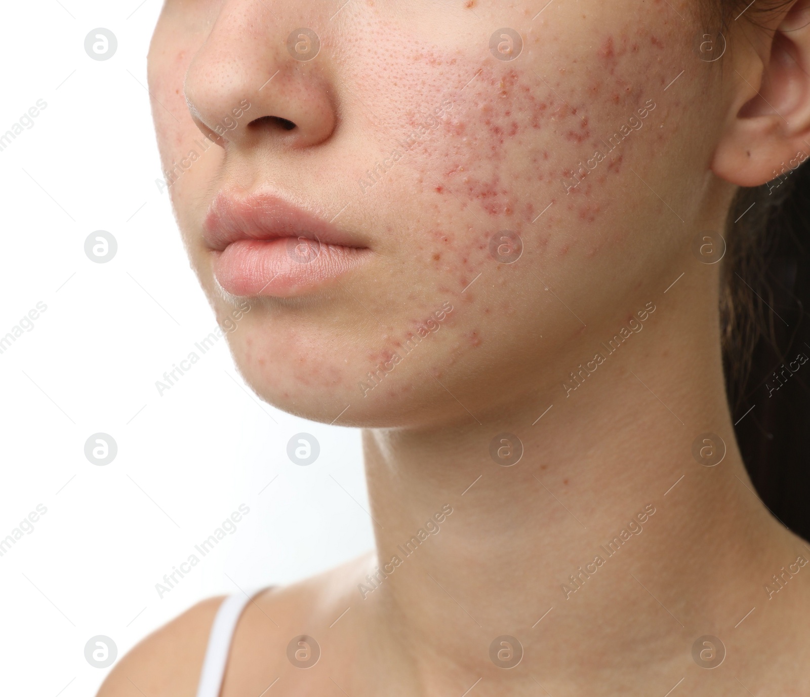 Photo of Teenage girl with acne problem on white background, closeup