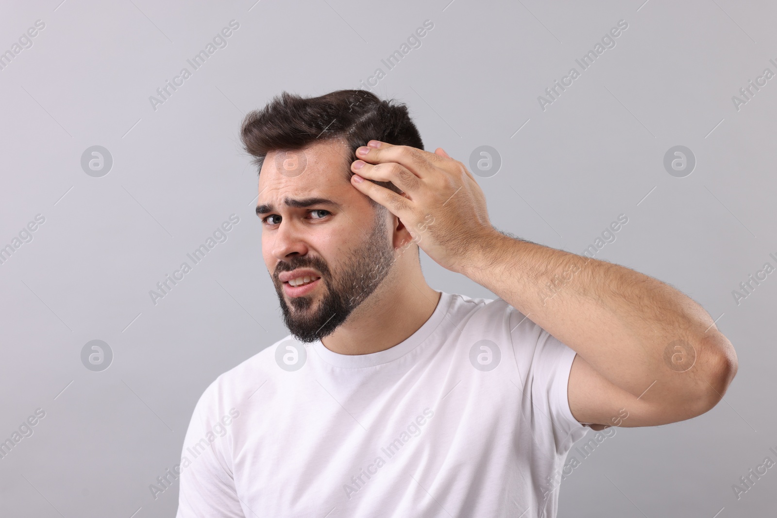 Photo of Emotional man with dandruff in his dark hair on light grey background