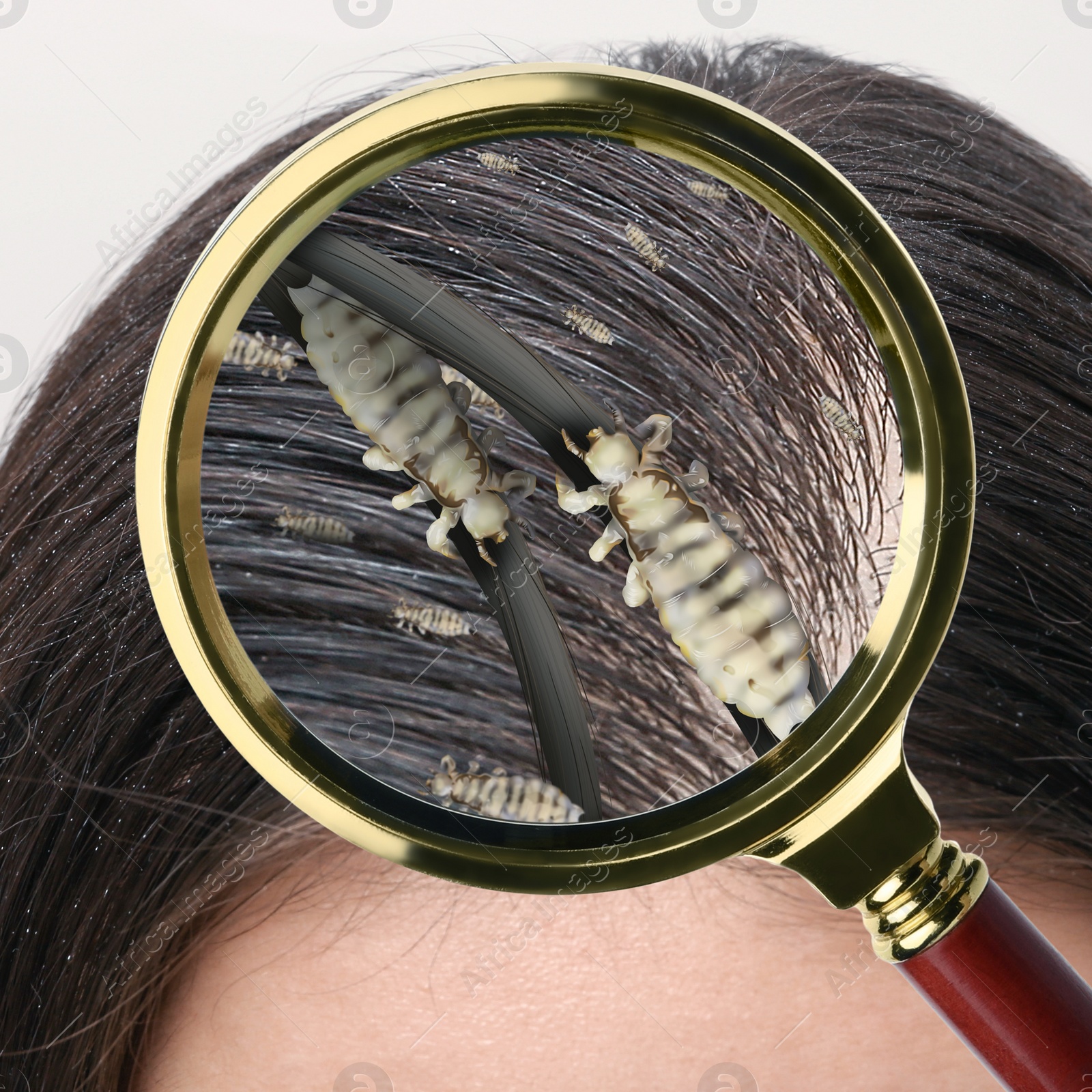 Image of Pediculosis. Woman with lice and nits, closeup. View through magnifying glass on hair