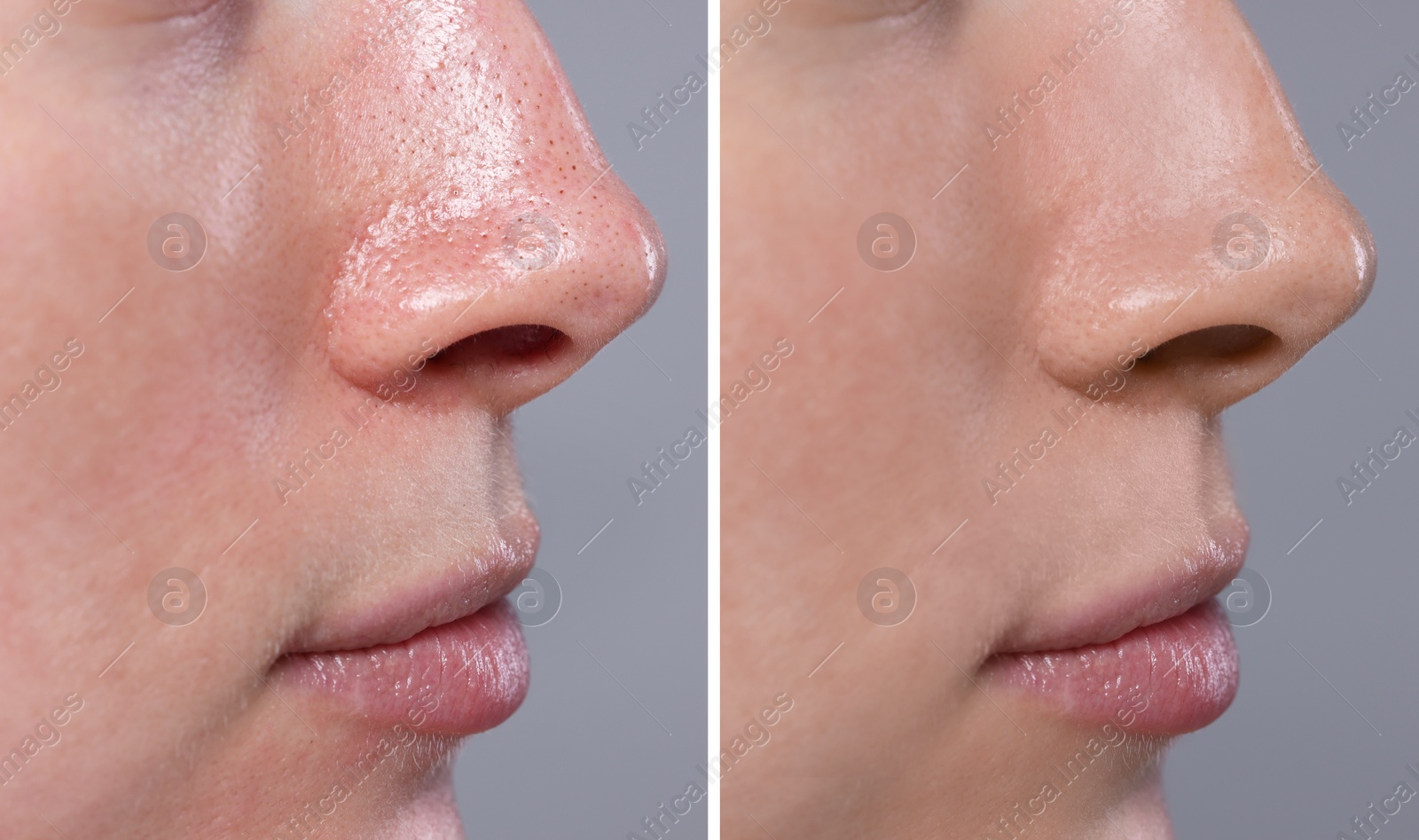 Image of Blackhead treatment, before and after. Collage with photos of woman on grey background, closeup view