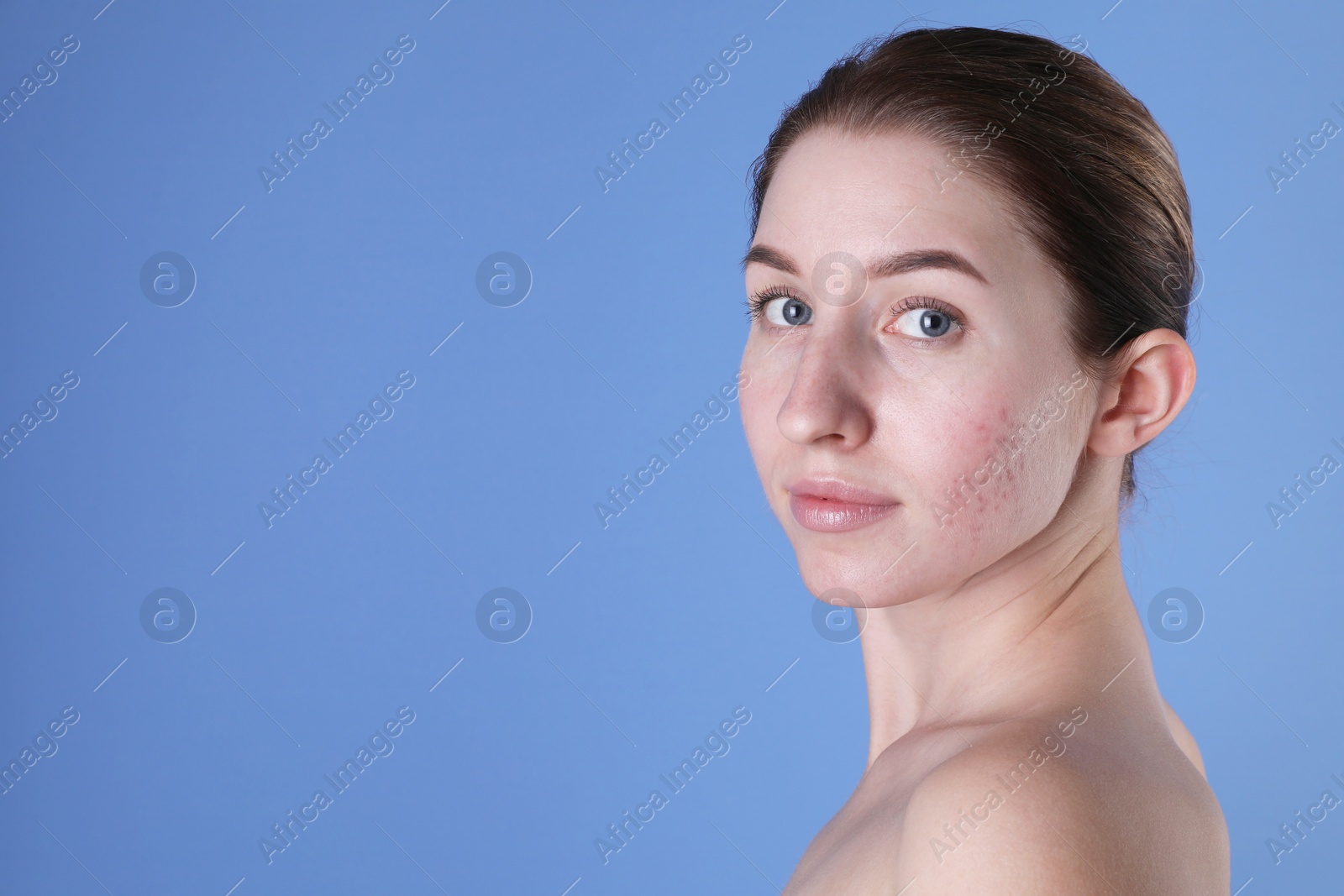 Photo of Young woman with acne problem on blue background. Space for text