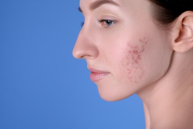 Young woman with acne problem on blue background, closeup. Space for text