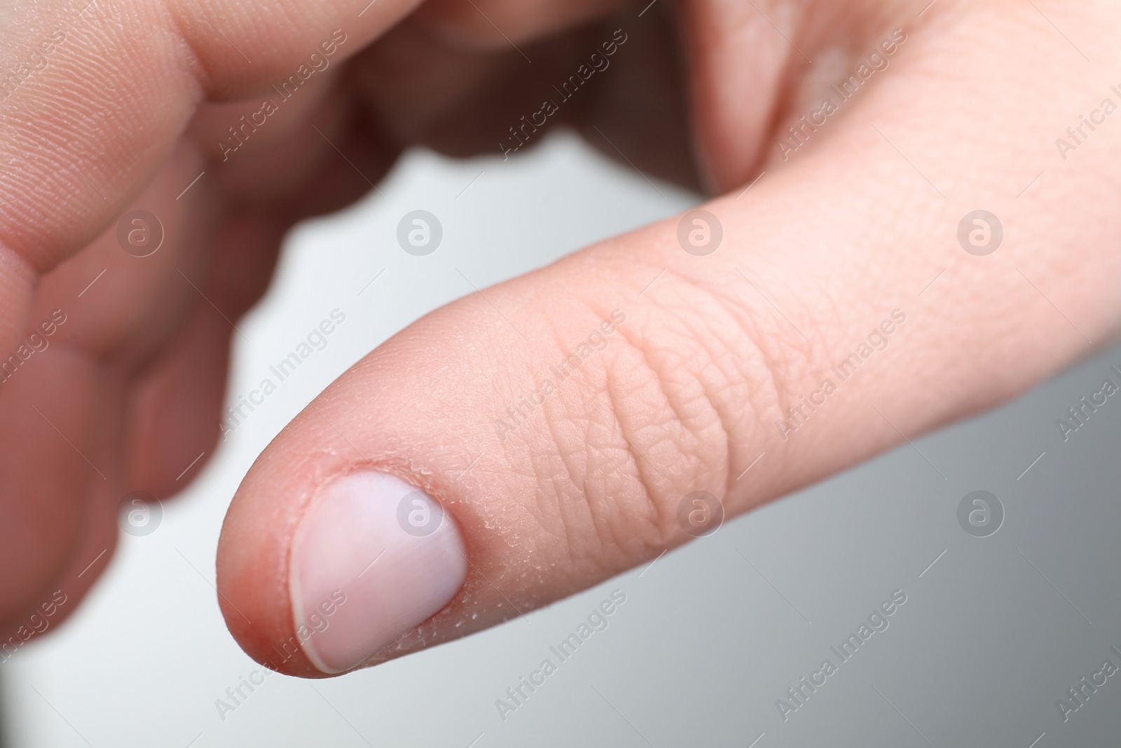 Photo of Woman with dry skin on hand against light background, closeup